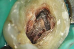 endodoncia-05 endodoncia-05