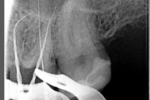 endodoncia-06 endodoncia-06