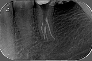 endodoncia-07 endodoncia-07